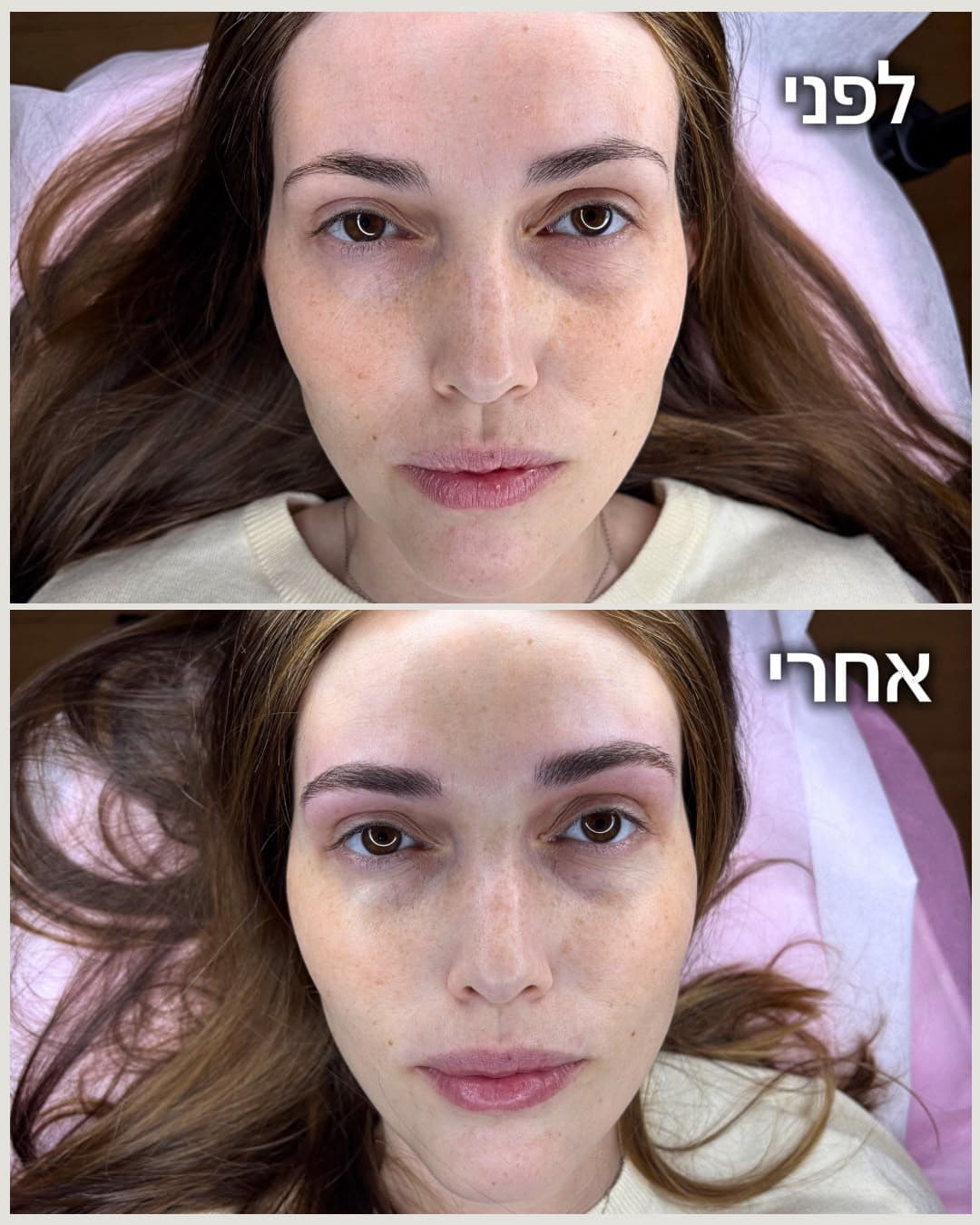 לפני ואחרי טיפול מיקרובליידינג