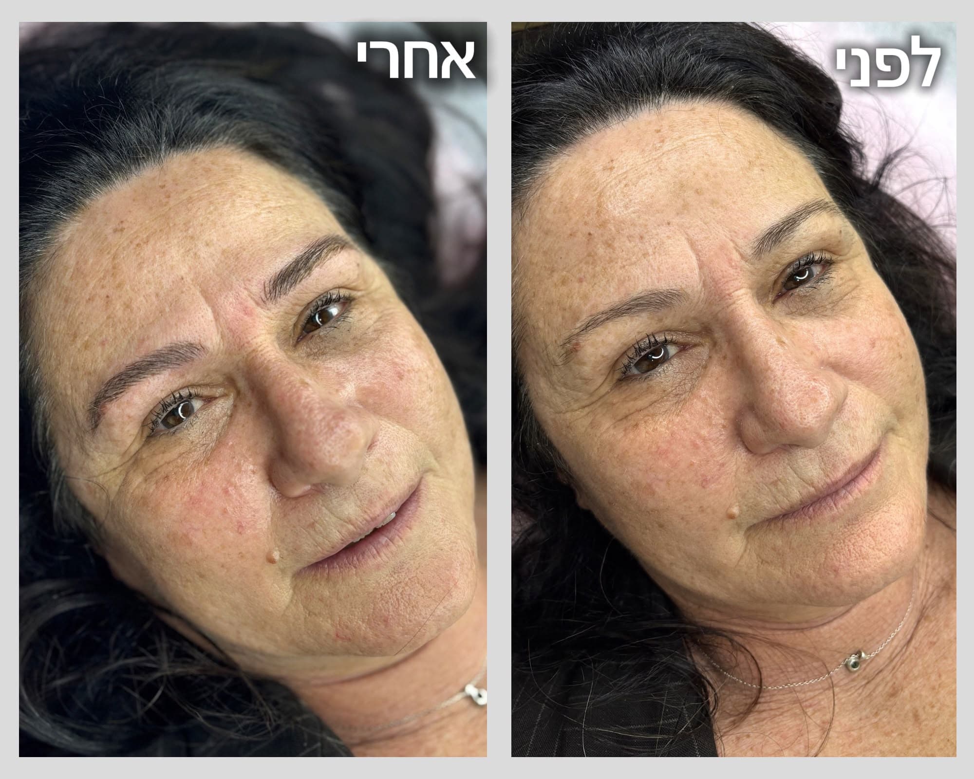 לפני ואחרי טיפול מיקרובליידינג